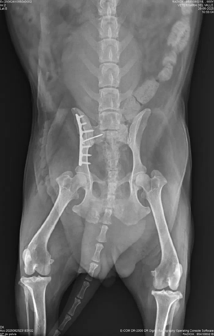 Radiografía de pelvis con placa en el ilion