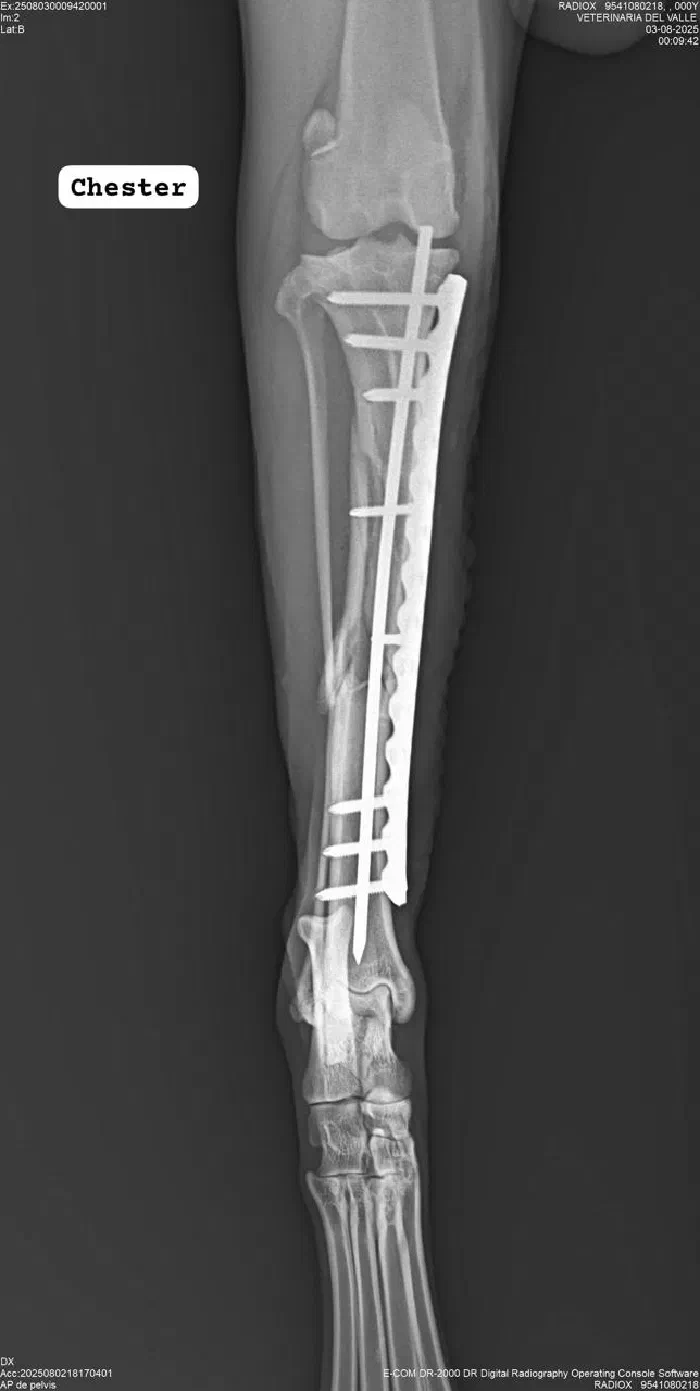 Radiografía de tibia con placa y tornillos